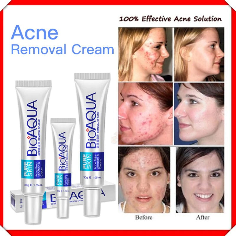 BIOAQUA FACE CREAM ANTI ACNE TREATMENT